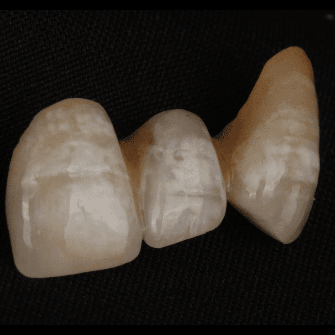 Three-unit porcelain bridge showing natural translucency