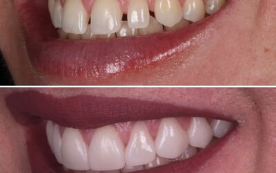 The Art of Shade Selection in Smile Makeovers: More Than Just Picking a Colour