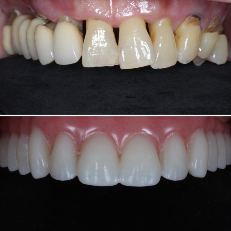 implant reconstruction