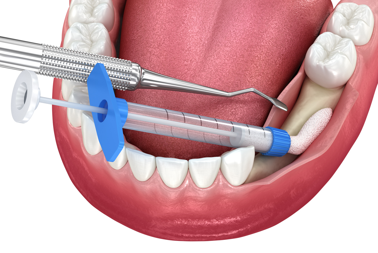 Bone Grafting