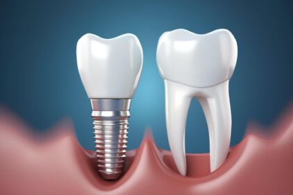 dental implants Vancouver