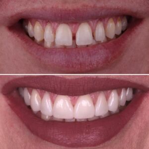 Dental Veneers