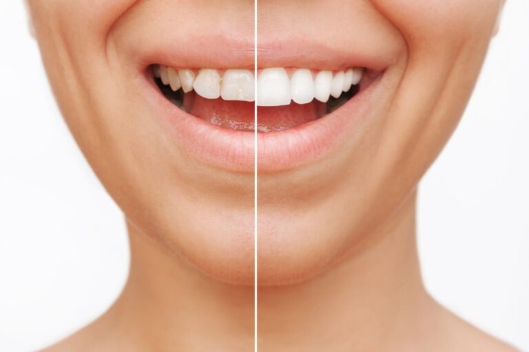 Dental Veneers cosmetics dentist near me