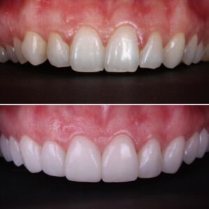 Dental Veneers