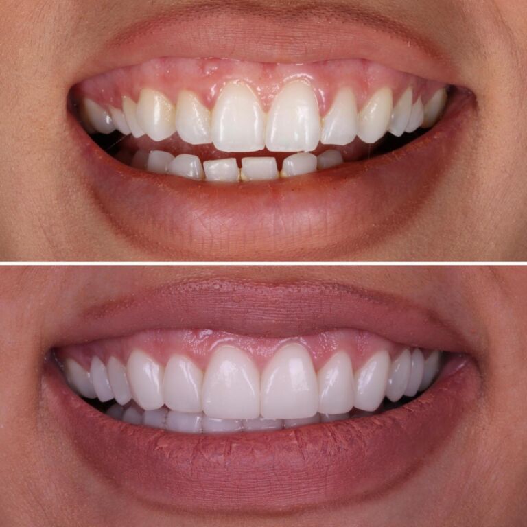 Gum Lifting