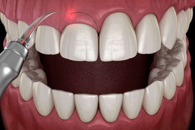 Gum Lifting Process 1