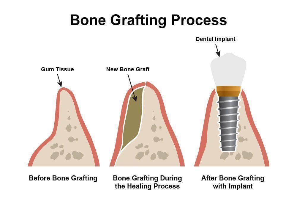 Bone Grafting and Dental Implants: A Comprehensive Guide by Specialists at Transcend Specialized Dentistry