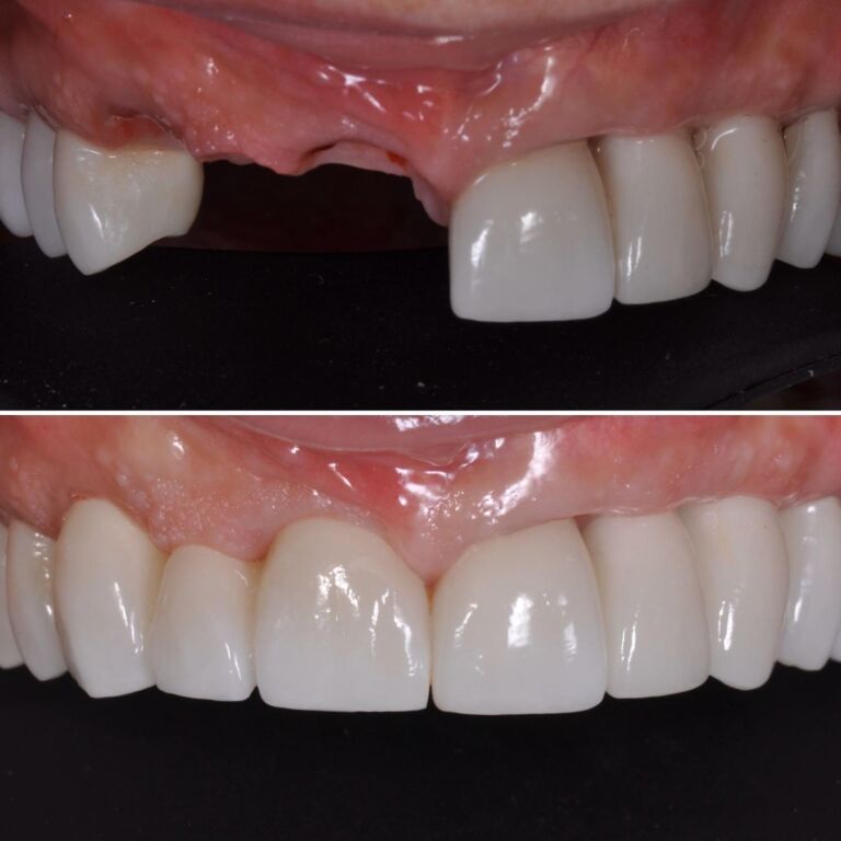Dental Implants before after e1691095276662