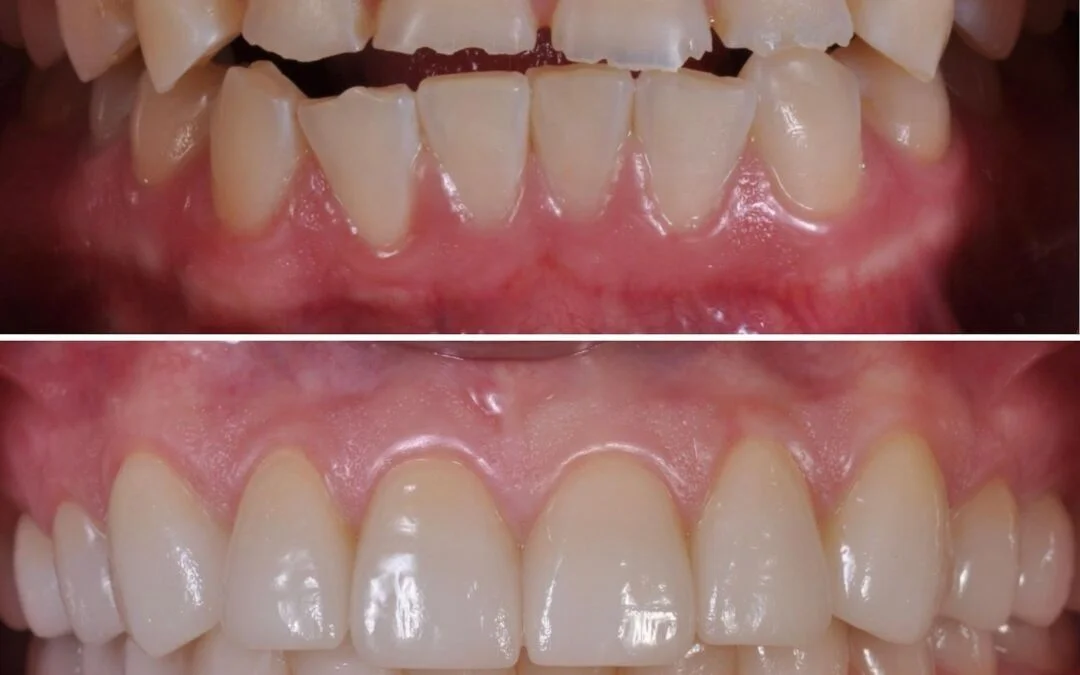 Dental Reconstruction Explained