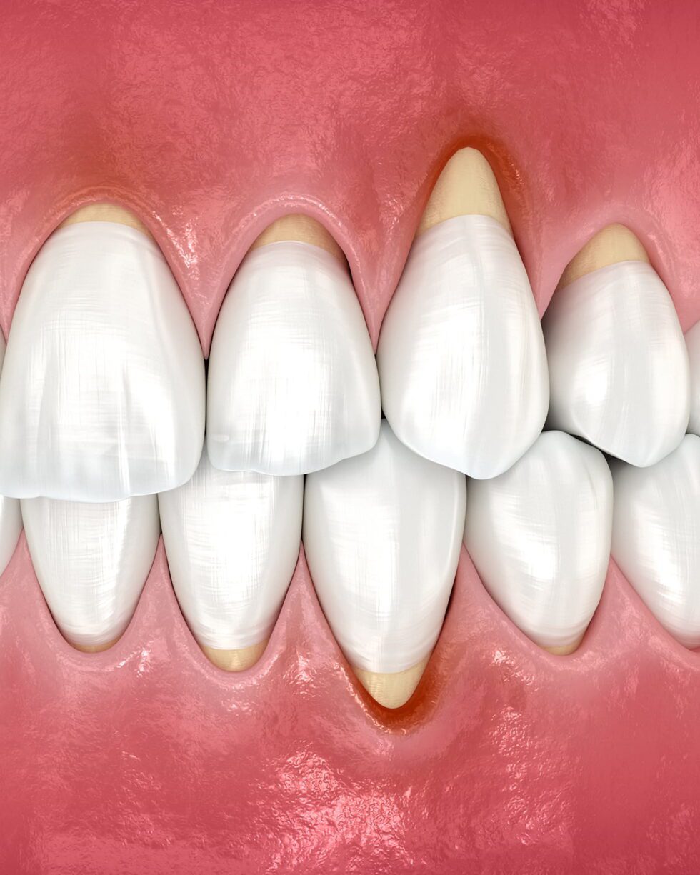 Gum Grafting Vancouver Expert Periodontist Transcend Dentistry