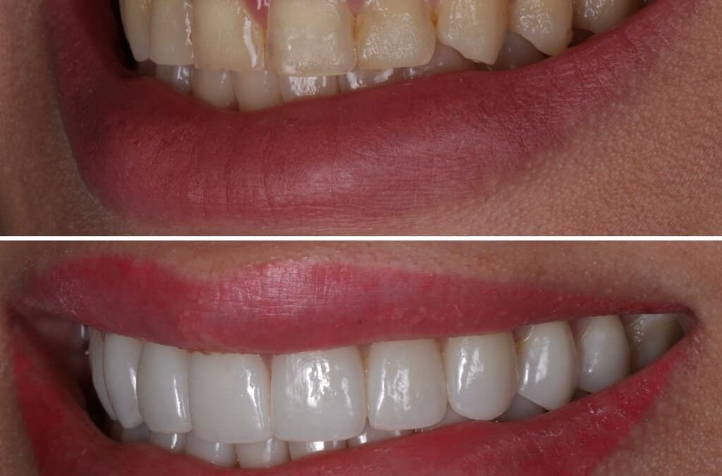 Not All Veneers Are Created Equal: The Variables That Matter