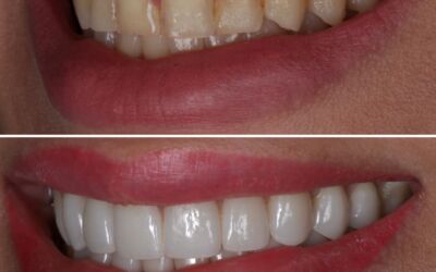 Not All Veneers Are Created Equal: The Variables That Matter