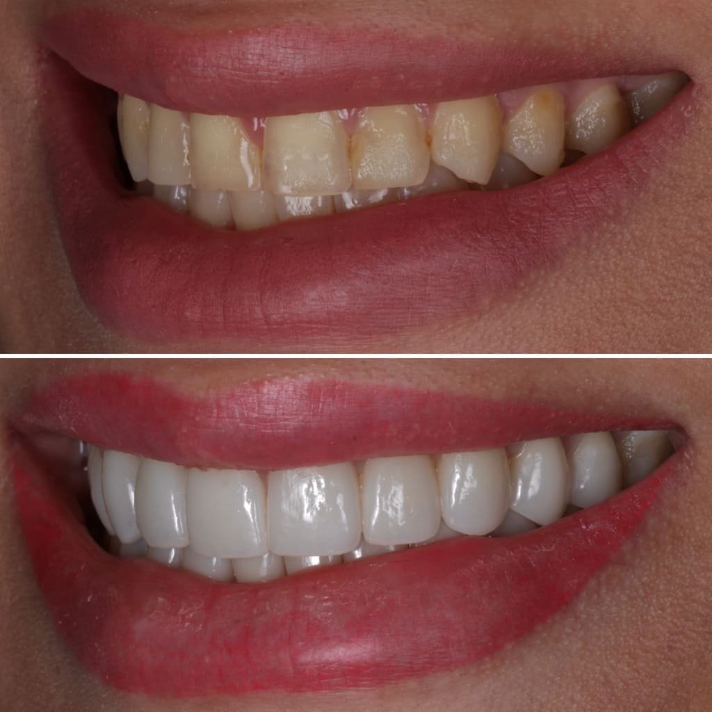 Dental Veneers