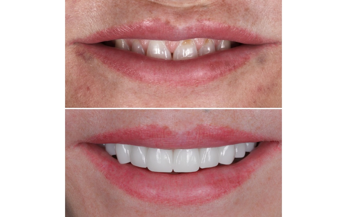 full mouth reconstruction 1 3