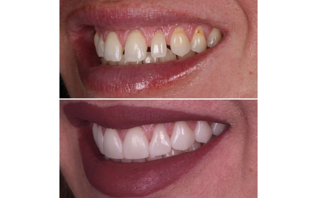 The Art of Shade Selection in Smile Makeovers: More Than Just Picking a Colour