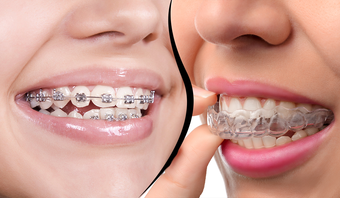Invisalign vs Braces: The Ultimate Guide to Choosing the Best Orthodontic Treatment in Vancouver