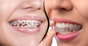 Invisalign vs braces