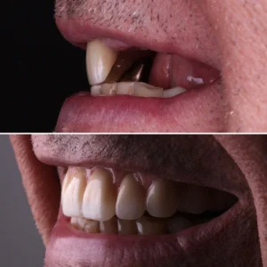 dental implants jpg