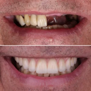 full arch implant reconstruction 2048x2048 jpg