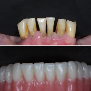 implant reconstruction 1 2048x2048 jpg