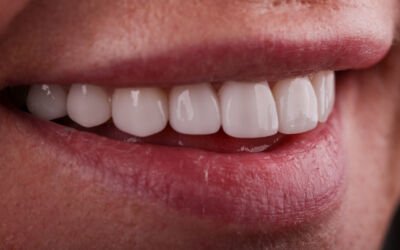 The Art and Science of Porcelain Veneers: Transforming Smiles with Precision and Beauty