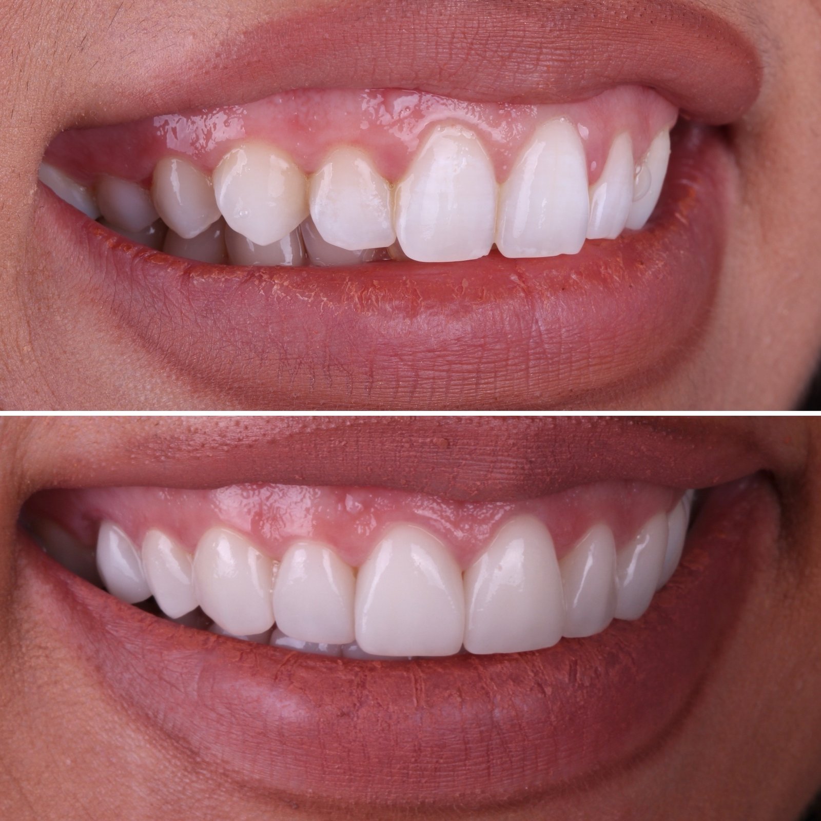 Veneers