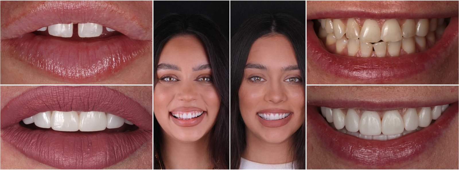 5 these 3 before and afters (You can put them on the blog separately as well see in this folder) (replace with Why Transcend for Your Porcelain Veneers ) (1)