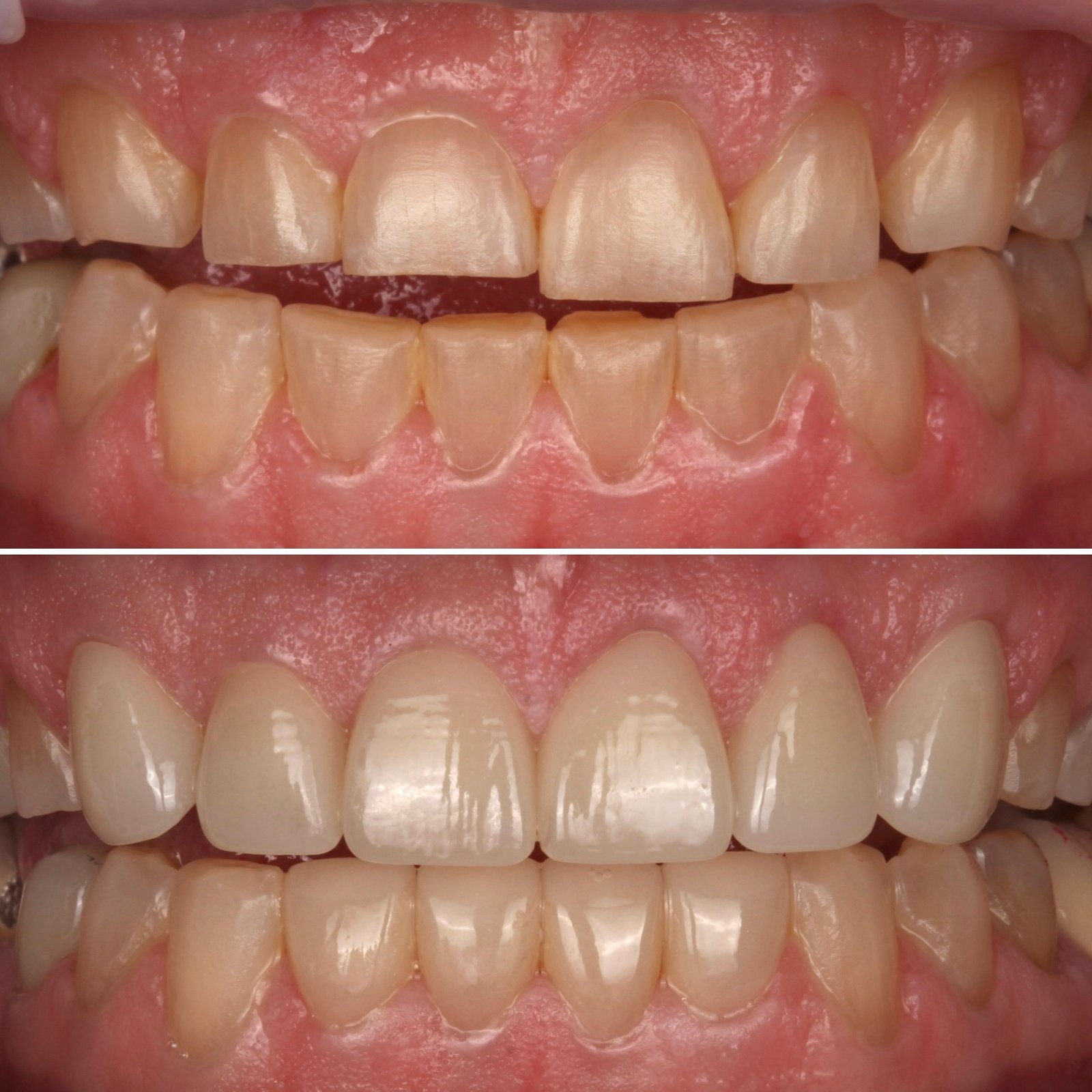 why choose veneers