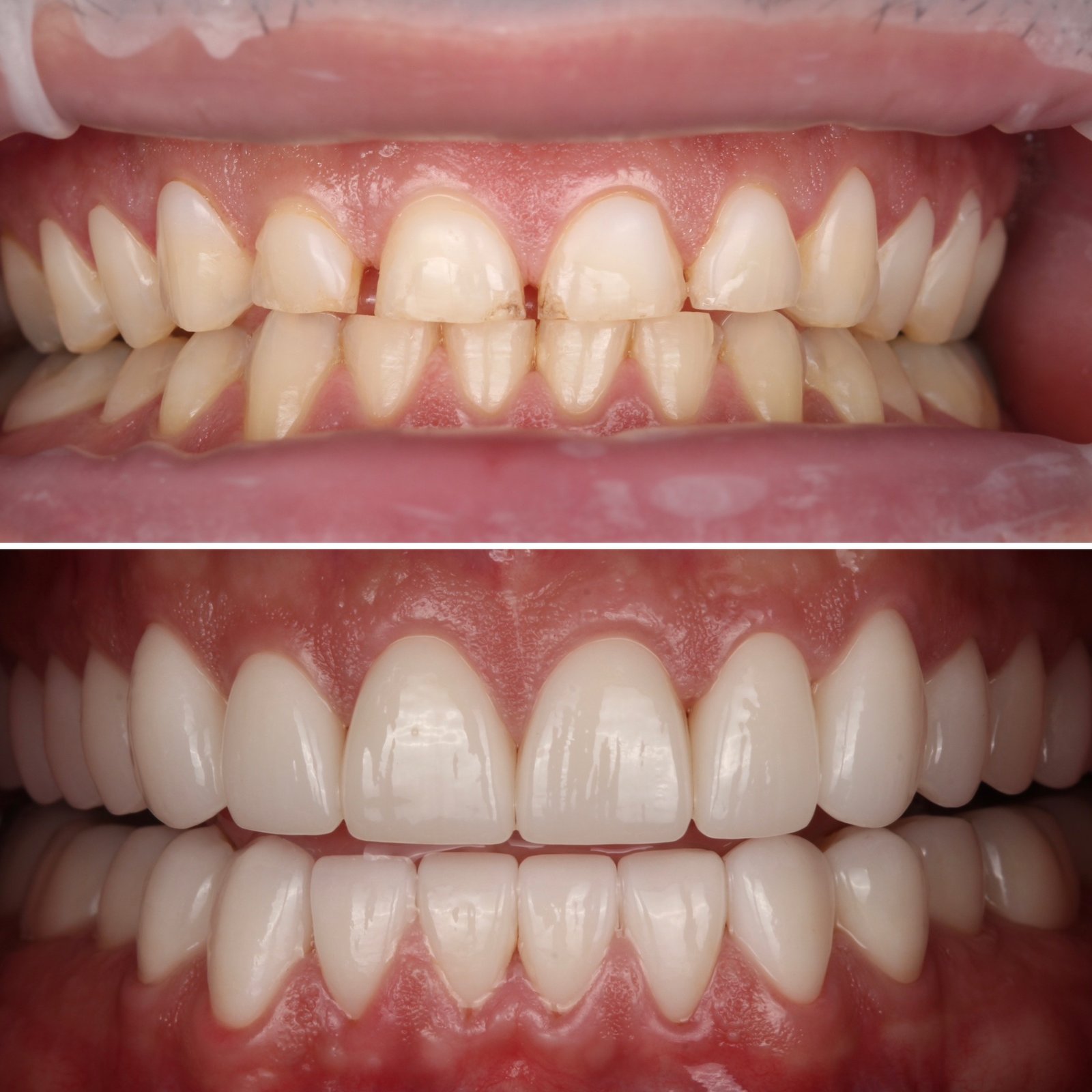 Choosing Between Veneers and Crowns ) (1)