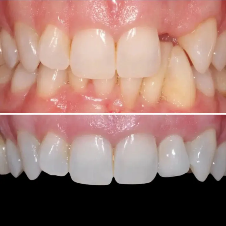 Before and after results of dental implant treatment at Transcend Dentistry in Vancouver showing improved smile and restored teeth.
