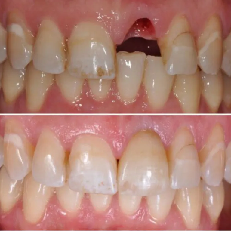 Single tooth dental implant placement at Transcend Dentistry in Vancouver restoring a missing tooth.