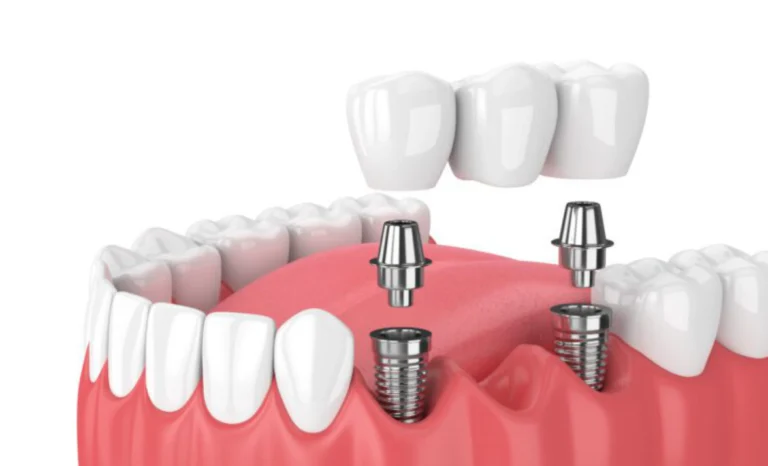 Dental implants in Vancouver at Transcend Dentistry showing natural-looking tooth replacement and restored bite function.