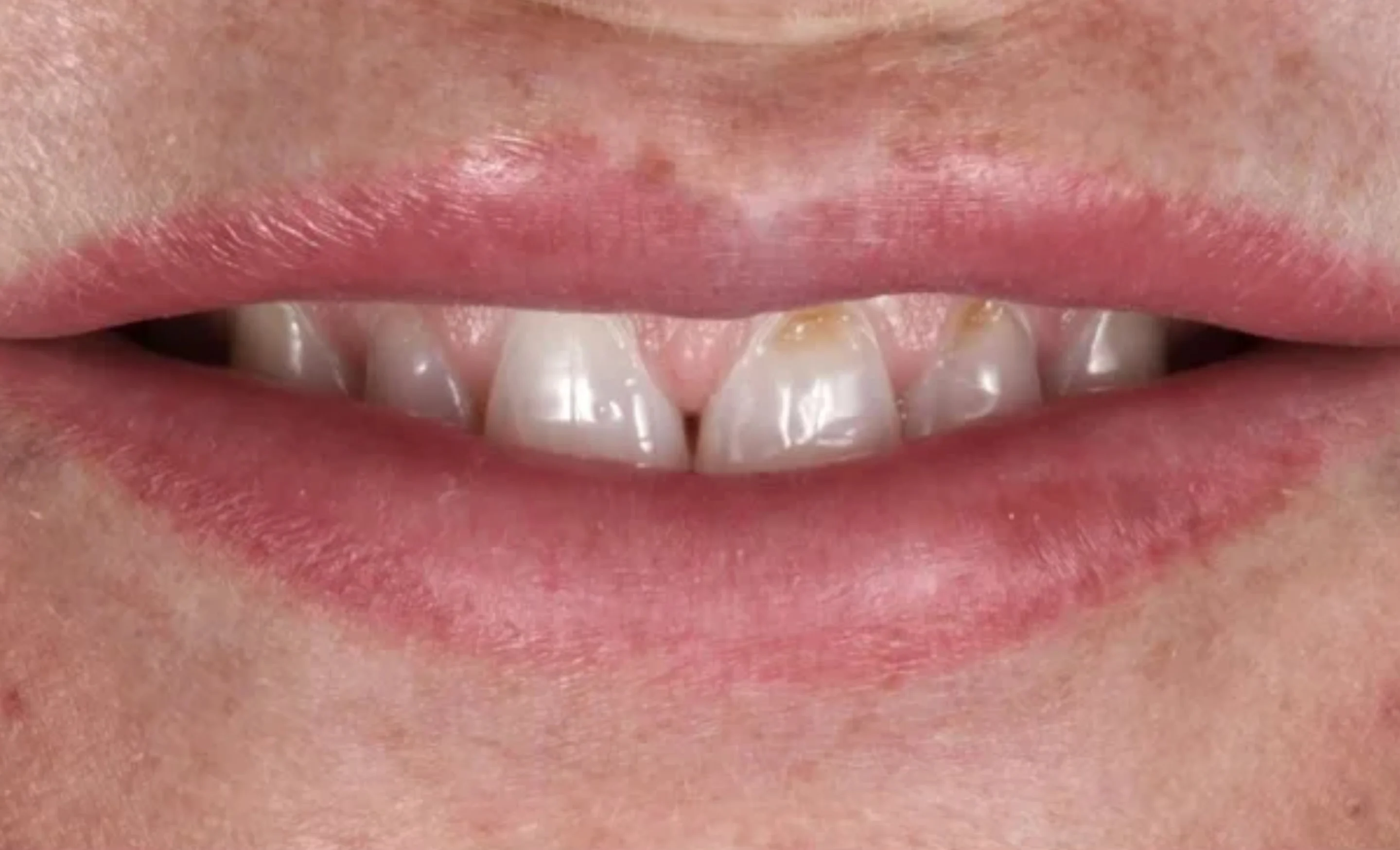 Before image of a smile makeover with veneers at Transcend Dentistry in Vancouver showing teeth prior to cosmetic veneer treatment.