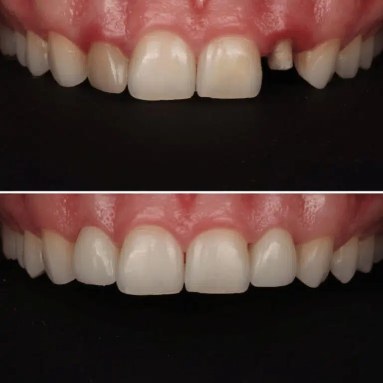 Before and after dental crowns at Transcend Dentistry in Vancouver showing restored tooth shape, strength, and natural-looking smile transformation.
