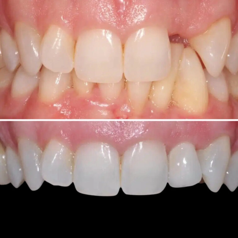 Before and after dental implants at Transcend Dentistry in Vancouver, Canada, showing restored teeth and a natural, confident smile.