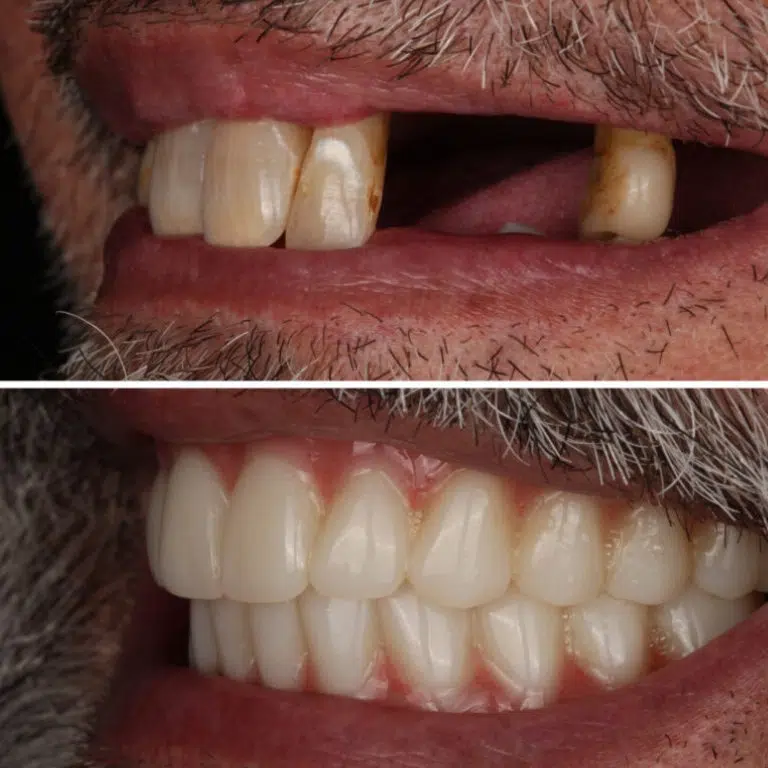 Before and after dentures at Transcend Dentistry in Vancouver showing restored smile, improved bite, and natural-looking full or partial denture results.