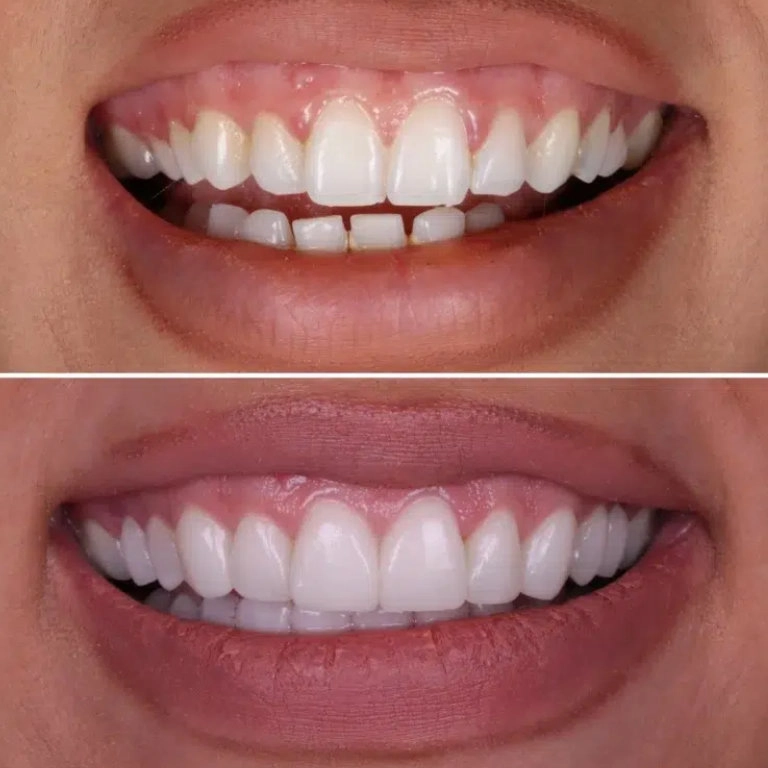 Before and after smile makeover with veneers at Transcend Dentistry in Vancouver, Canada, showing natural-looking cosmetic dental transformation.