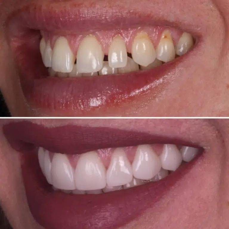 Before and after gum grafting at Transcend Dentistry in Vancouver showing restored gum tissue, reduced recession, and improved smile health.