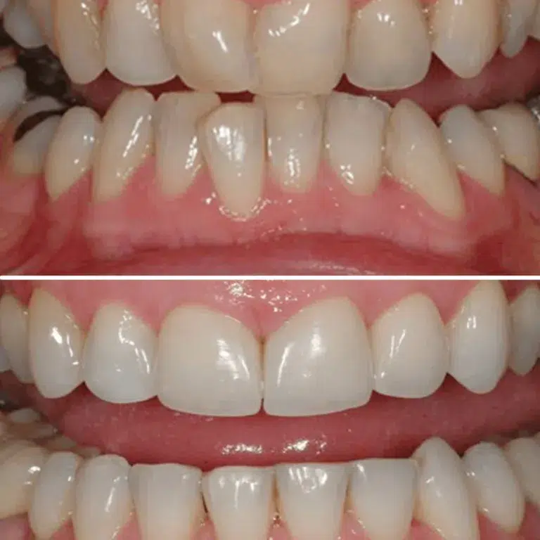 Smile Makeover - Before and after braces/Invisalign at Transcend Dentistry in Vancouver showing straighter teeth, improved alignment, and enhanced smile aesthetics.