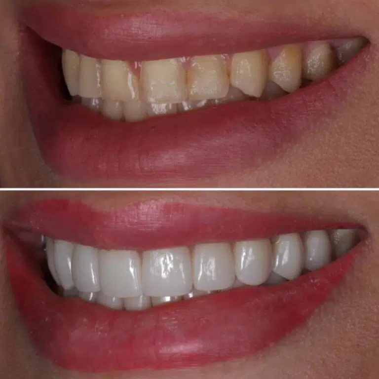 Before and after smile makeover with veneers at Transcend Dentistry in Vancouver, Canada, showing natural-looking cosmetic dental transformation.