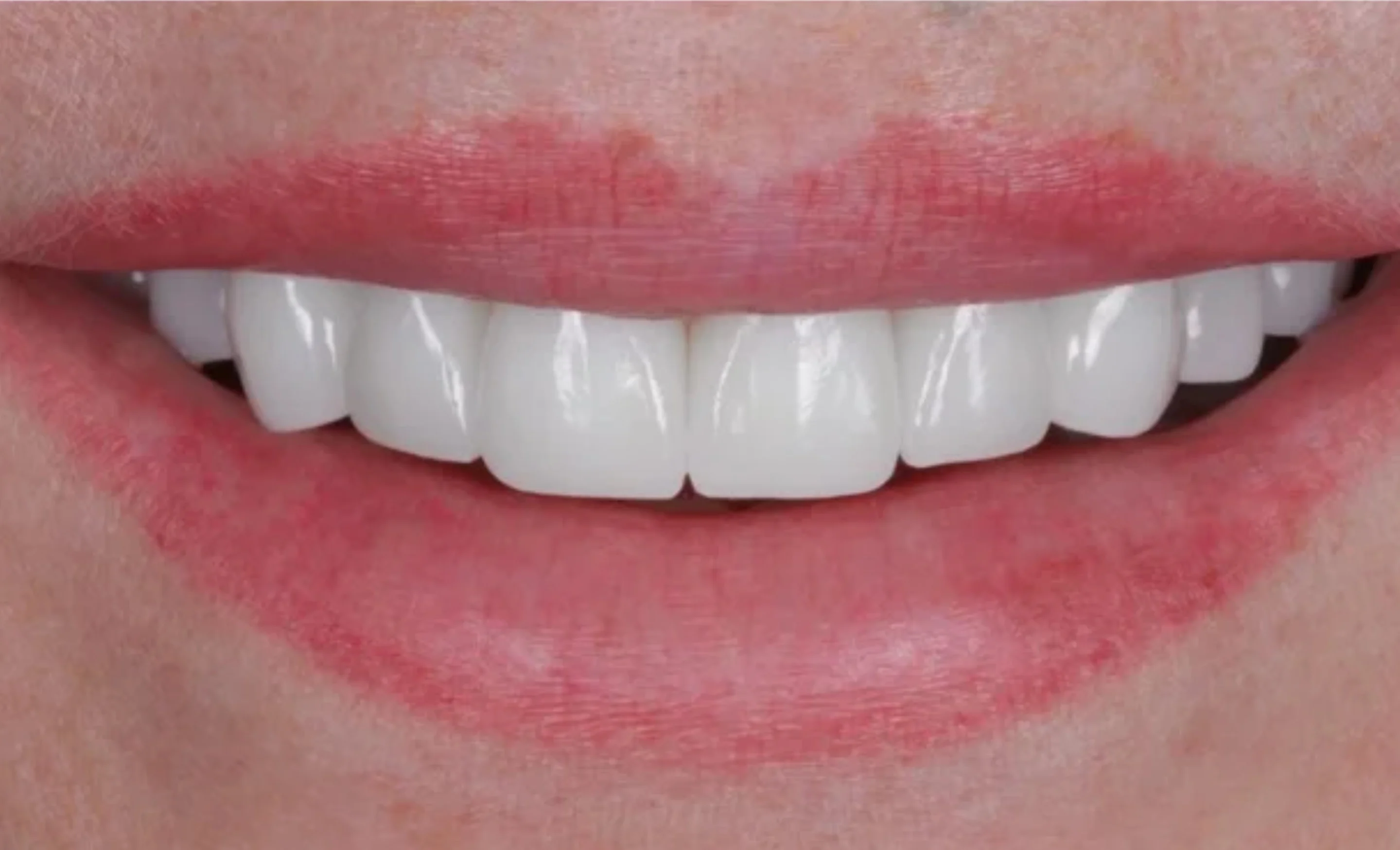 After image of a smile makeover with veneers at Transcend Dentistry in Vancouver showing natural, radiant, and fully restored teeth.